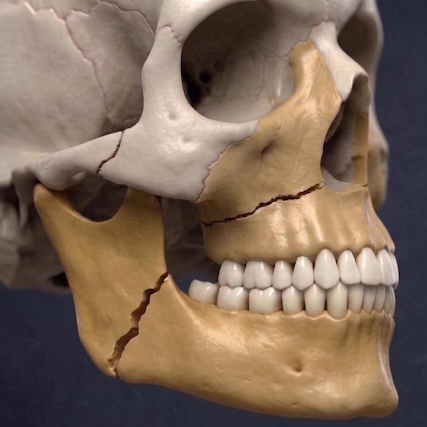Broken jaw showing fractures of the mandible and maxilla affecting the lower and upper jaw and overall bite alignment
