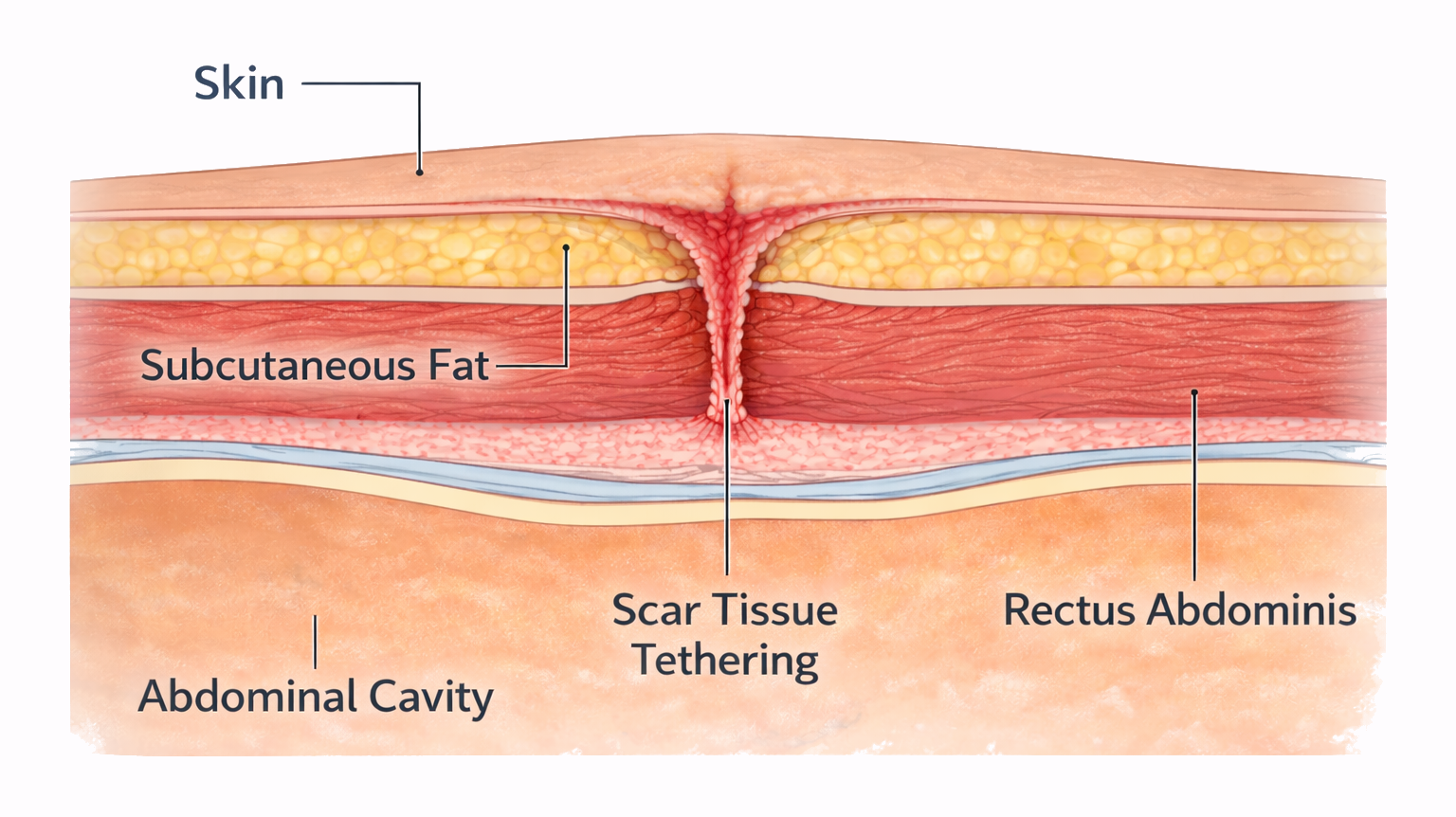 Cross-sectional diagram showing C-section scar tethering where scar tissue fixes skin to deeper layers of the abdominal wall.