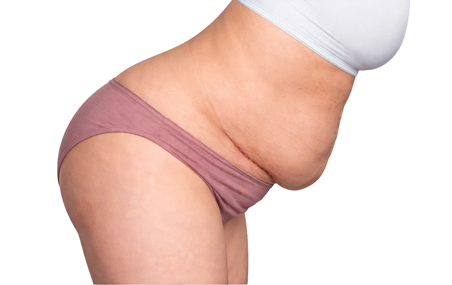 Side-on view of a lower abdominal shelf above a C-section scar becoming more noticeable when sitting or bending.