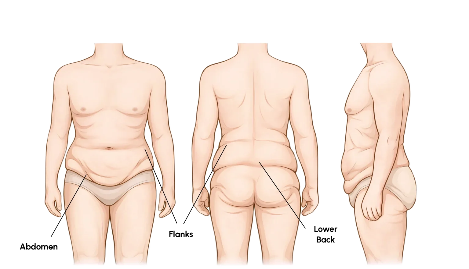 Front, back and side illustrations showing circumferential loose skin after weight loss affecting the abdomen, flanks and lower back