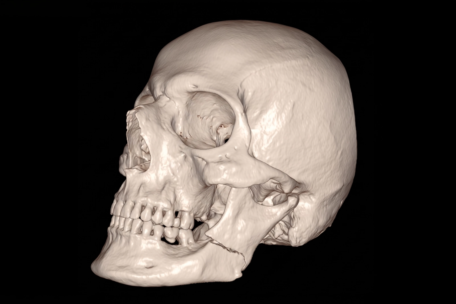 CT scan showing a broken jaw with a mandible fracture involving the angle and ramus with displacement