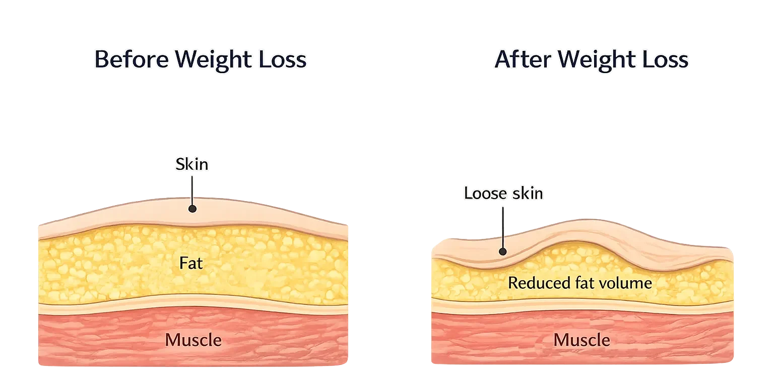 Cross-sectional diagram showing how reduced fat volume after weight loss can leave loose skin above the abdominal wall