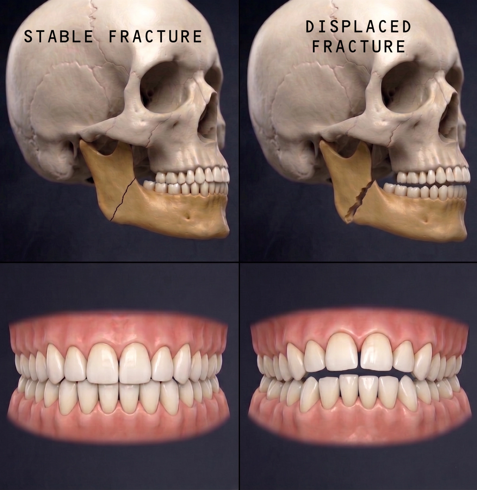 Comparison of stable and displaced jaw fractures showing how a broken jaw can affect bite alignment