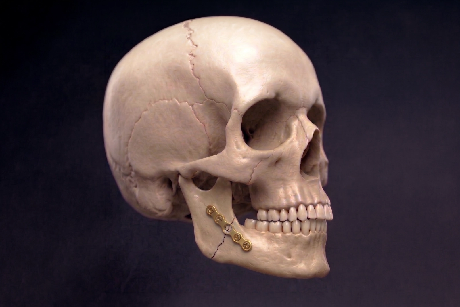 Broken jaw treated with plates and screws showing surgical fixation of a mandible fracture