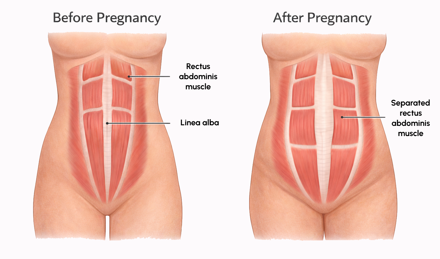 Illustration showing rectus diastasis after pregnancy where abdominal muscles separate along the midline.