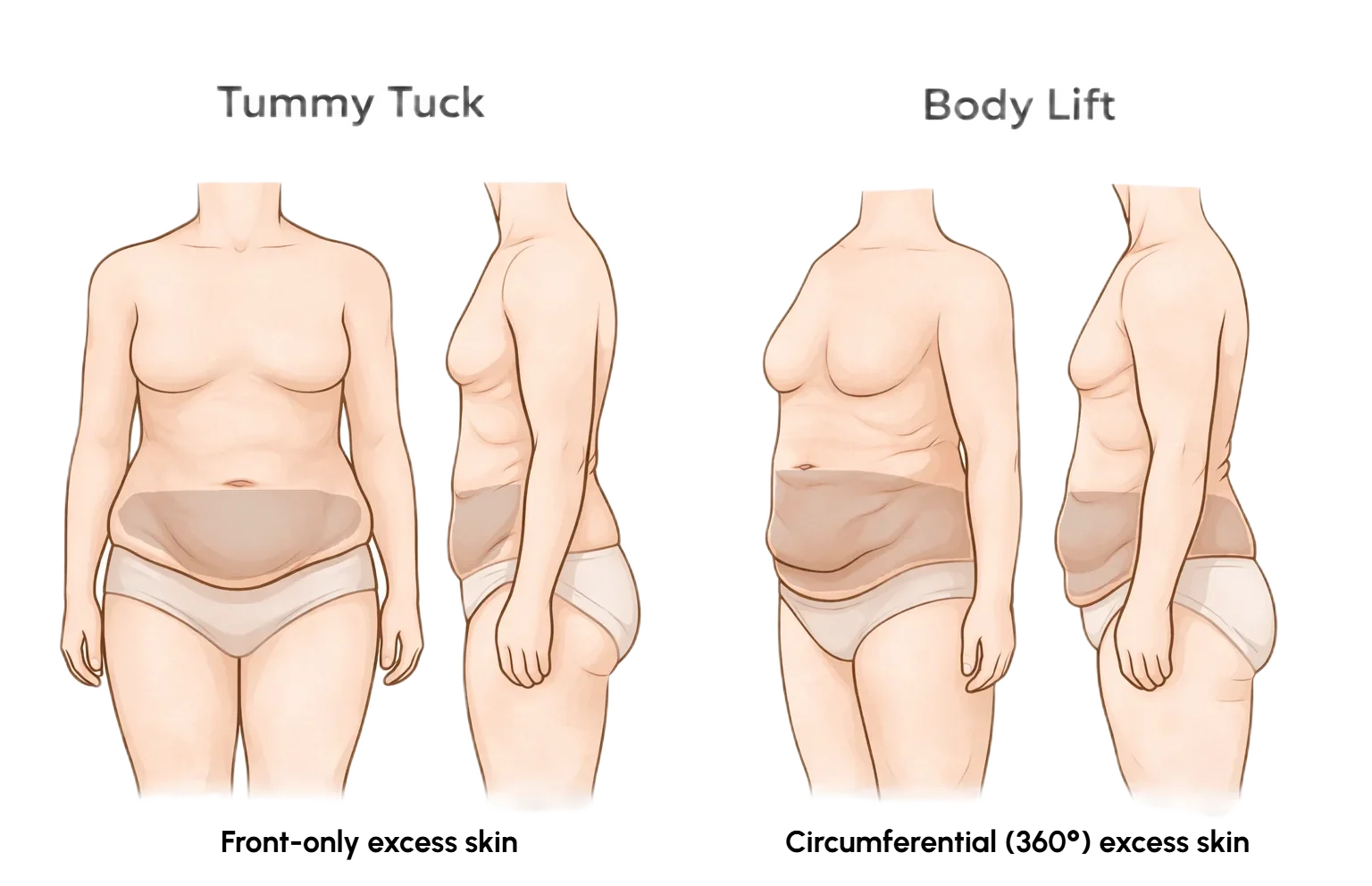 Comparison illustration showing tummy tuck for front-only loose skin and body lift for circumferential lower torso loose skin after weight loss