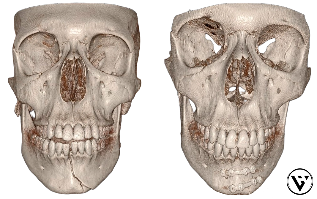 Mandibular fracture before and after surgical stabilisation using plates and screws.