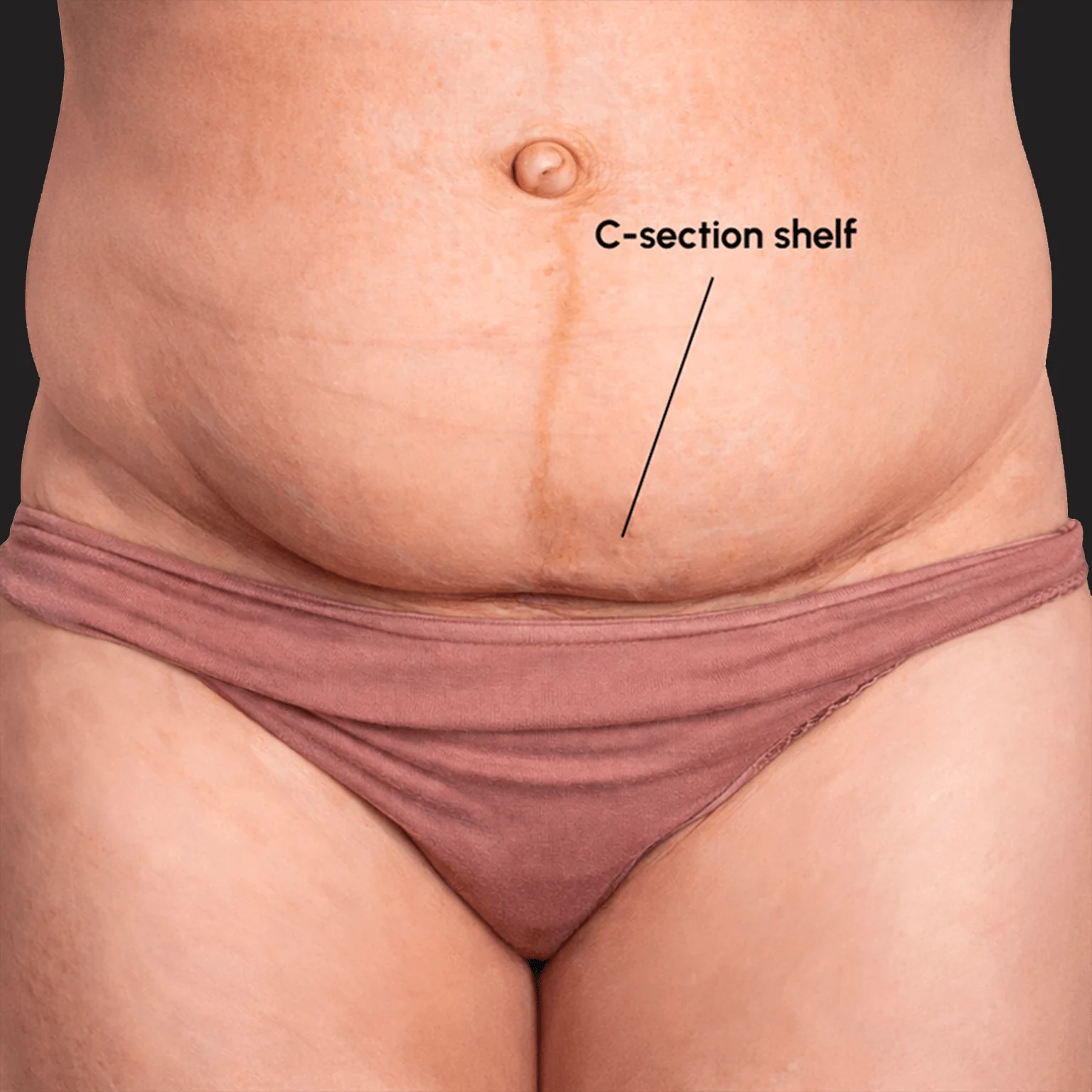 C-Section Shelf (C-Section Pouch): Why It Happens and How to Fix the Lower Belly Bulge