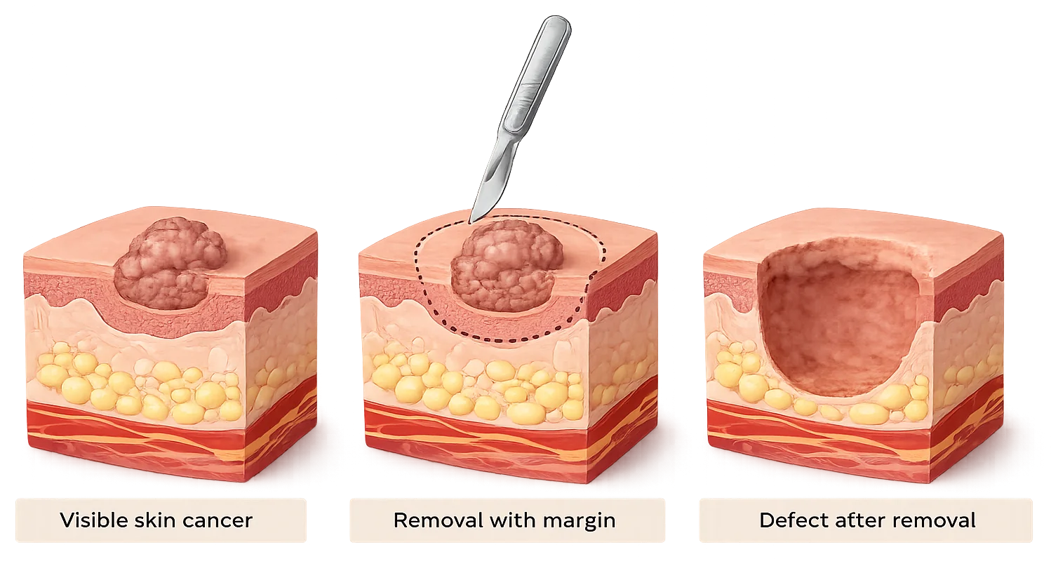 Diagram showing visible skin cancer, removal with a surgical margin, and the defect left after excision.