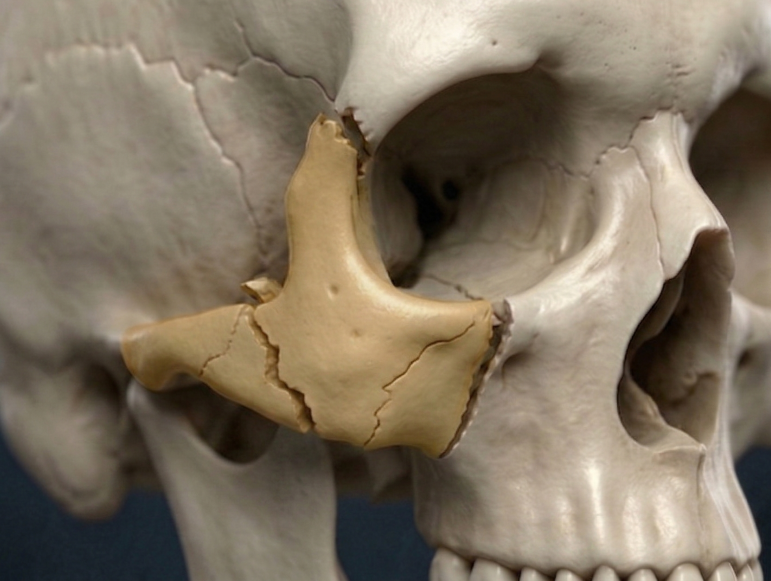 Cheekbone fracture showing the zygomatic bone with visible fracture lines
