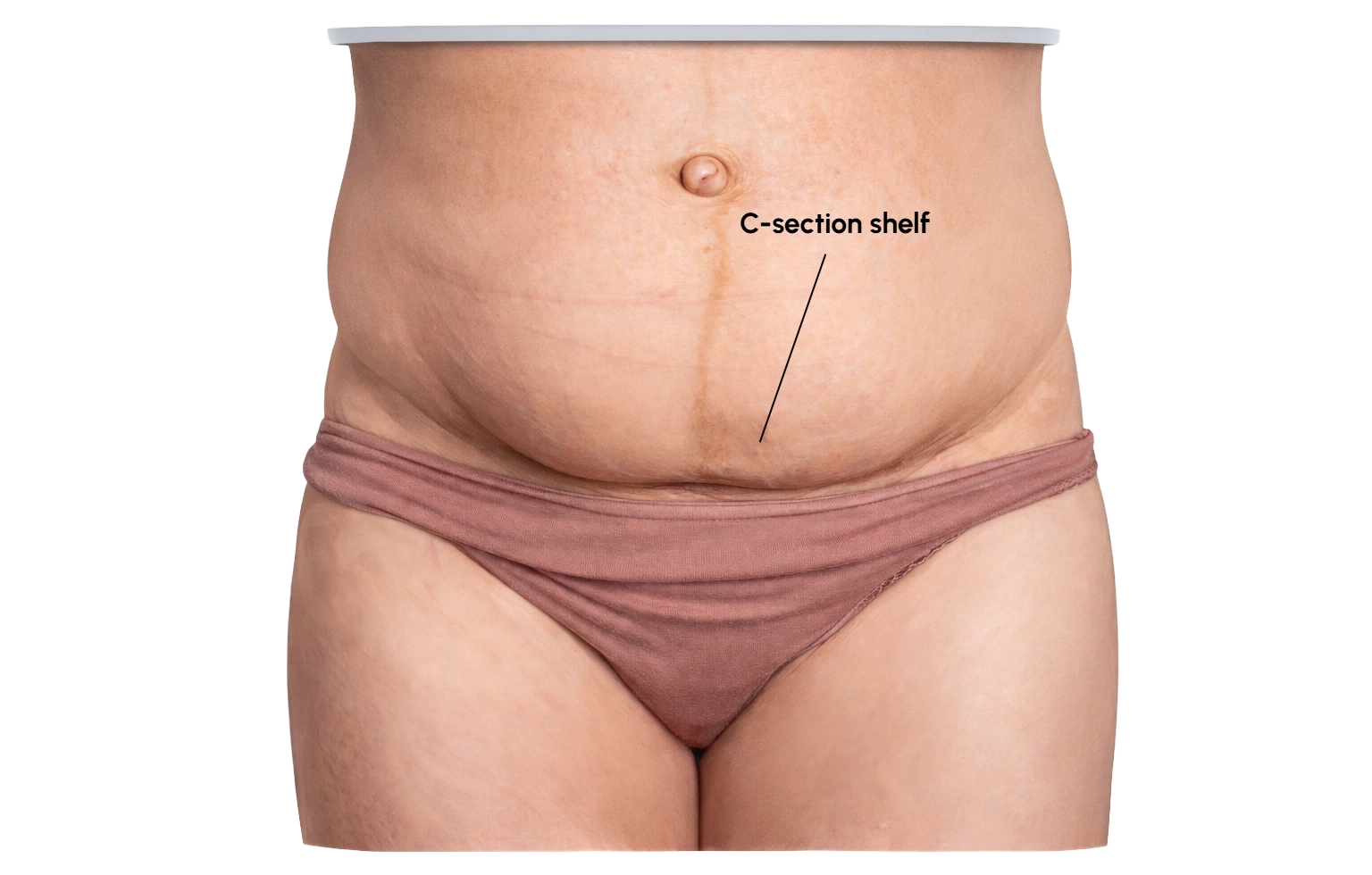C section shelf or lower abdominal bulge after pregnancy showing that visible contour change does not automatically mean Medicare eligibility