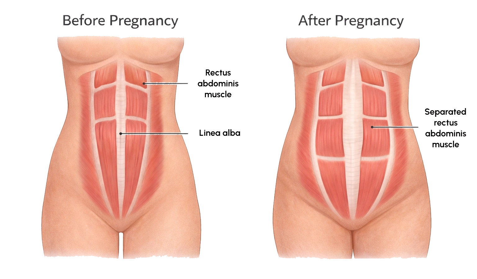 Before and after pregnancy diagram showing rectus diastasis with separation of the rectus abdominis muscles